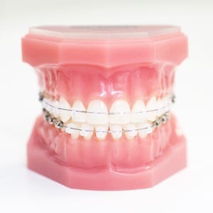 Precision Orthodontics - Clear braces